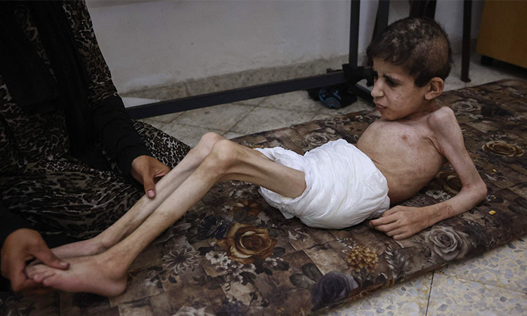 Gazakid-skindisease-hunger